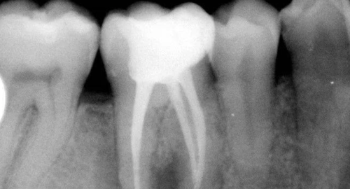 根管封药错把氢氧化钙封成iroot-sp?闯祸了!