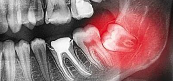 1例拔牙引起医疗事故鉴定引发的思考