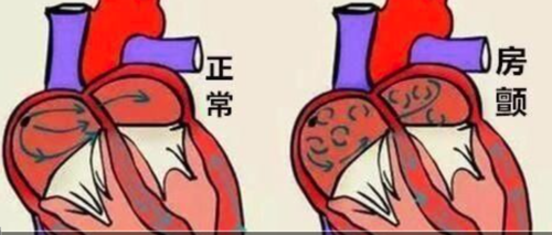 关于房颤的核心知识点,你都掌握了吗?