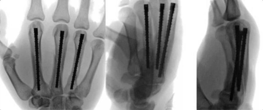 如何精准施策？掌骨骨折的治疗方案全景解读