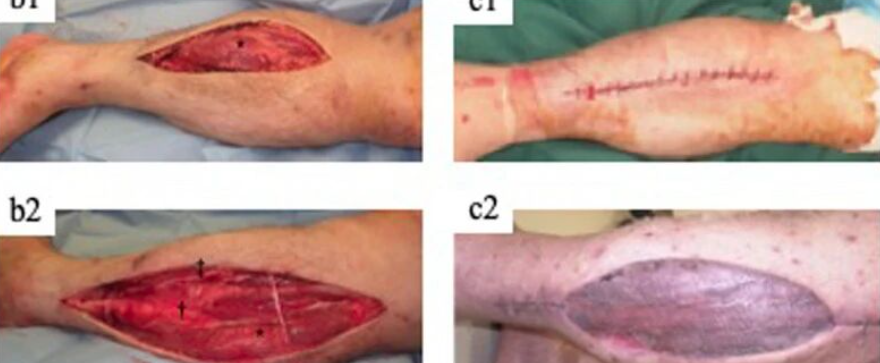 ​四室告急！因树木砸伤导致多部位骨筋膜室综合征，如何治疗？