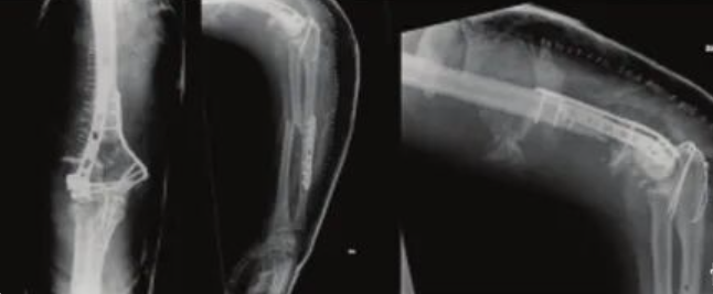 多发性创伤患者的漂浮肘：时机和手术策略