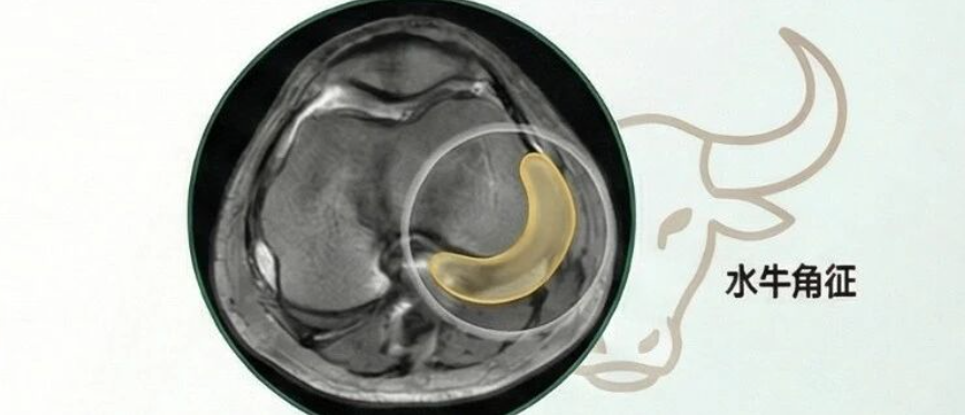 【手术理念】桶柄样撕裂，别只看矢状位