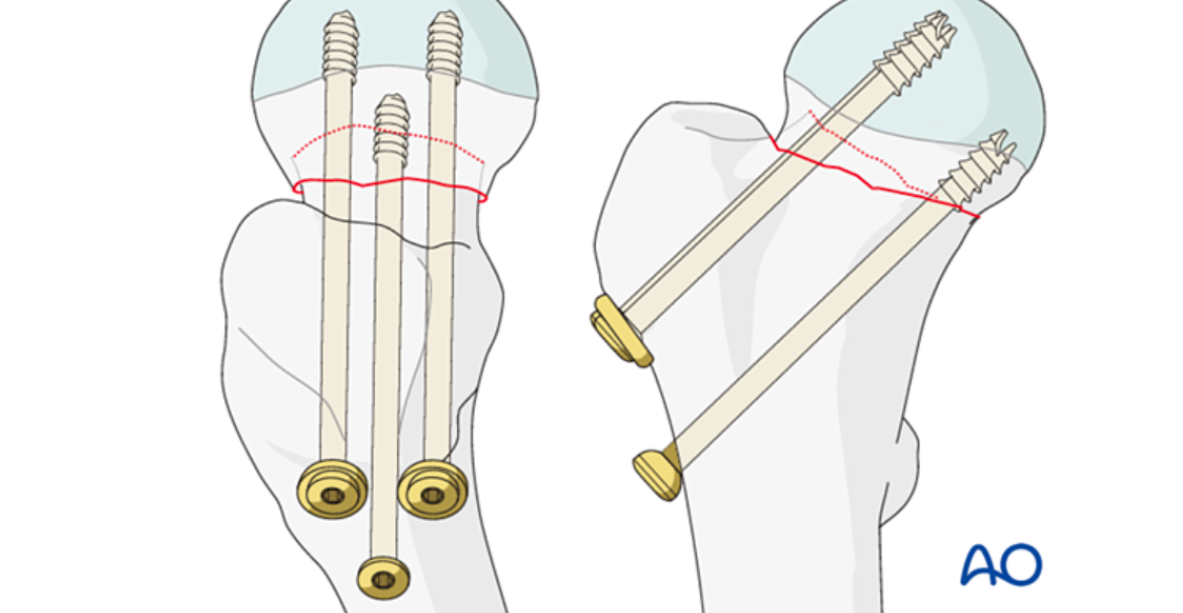 股骨颈骨折选空心钉、交叉全螺纹钉与FNS怎么选？看原理及证据