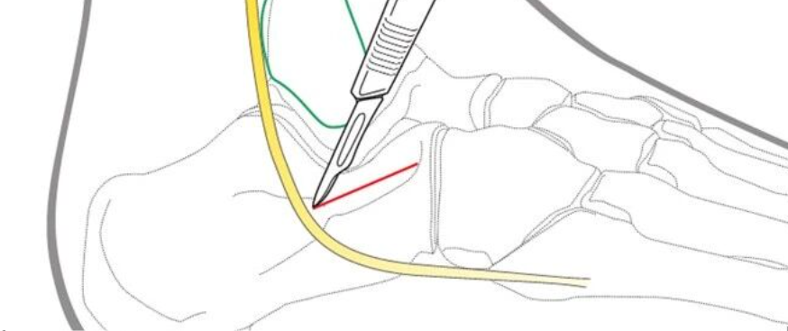 跟骨的跗骨窦入路（AO官网版）
