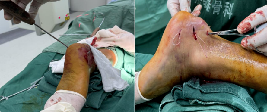 微创空心螺钉结合NICE结固定技术在治疗跟骨鸟嘴样骨折中的应用