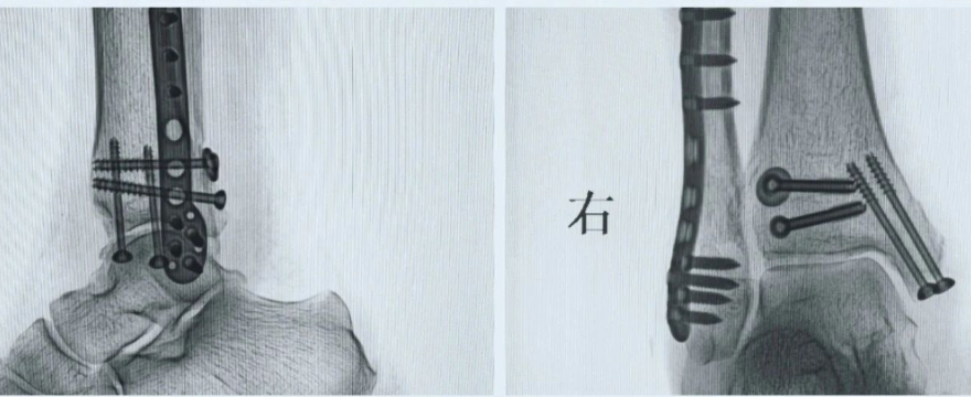 股骨干骨折，为什么“能闭合，不切开；能髓内，不钢板；能顺应，不逆行。”