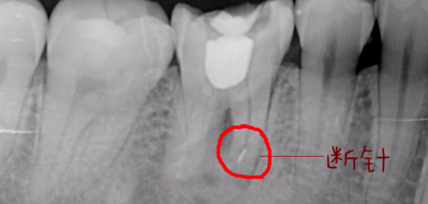 女子根管治疗后落下断针，法院为何判决不予理赔？