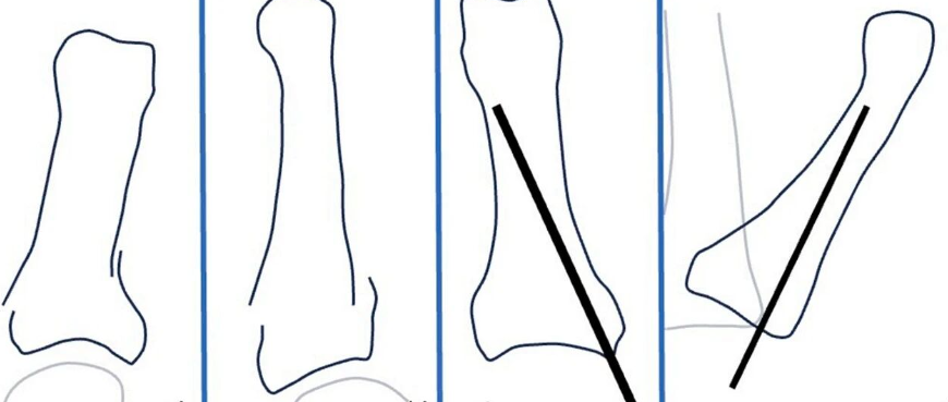 避开软骨与肌腱：日本专家创新斜置螺钉技术（oblique technique），实现指骨骨折微创固定