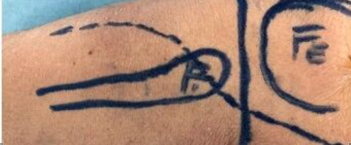 一篇关于改良Frosch入路治疗后外侧胫骨平台骨折的技术说明