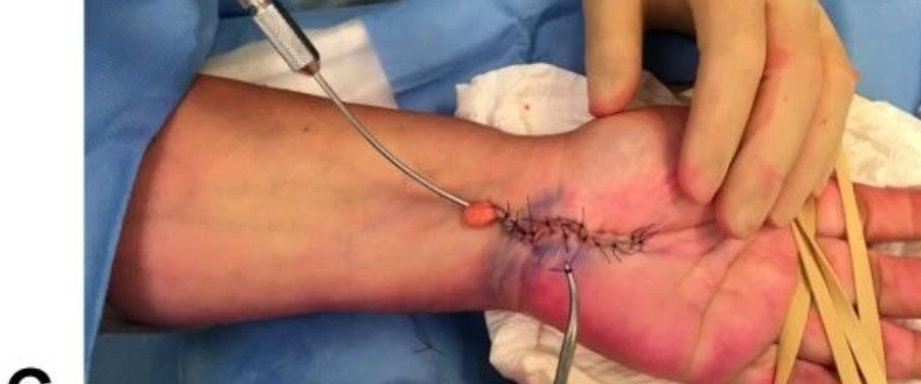 神经松解术联合自体脂肪移植治疗顽固性腕管综合征