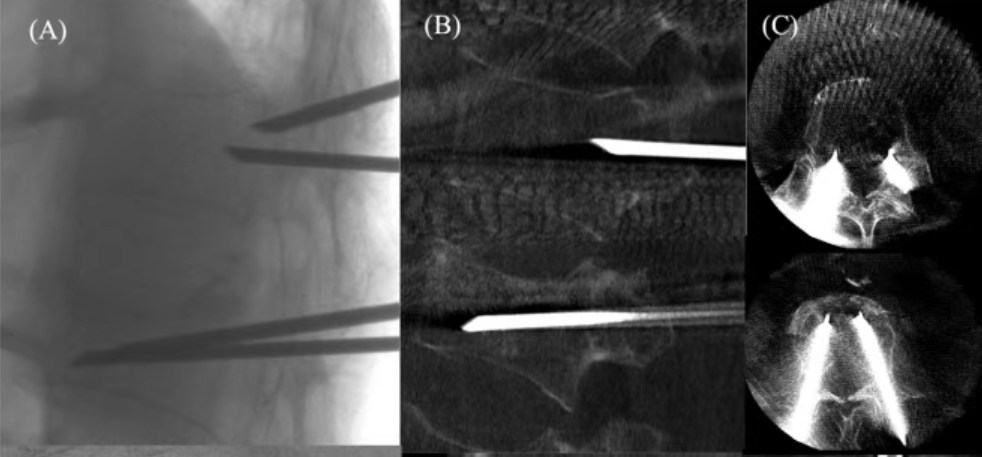 经皮椎体成形术步骤、技巧和注意事项：来自20篇论文的总结