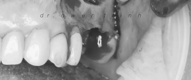 注意！根尖牙槽骨薄或脓肿，上颌窦黏膜撕裂风险高