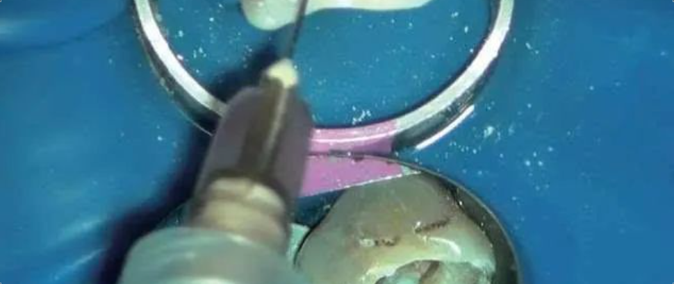 乳牙牙髓感染的根管治疗技术，这几点能帮助到你！