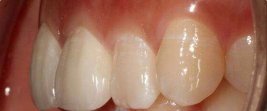 失活剂引起根尖周炎的治疗方法