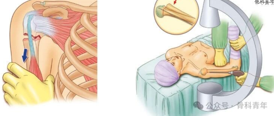 手术技巧 | 低切迹钢板联合“钉中钉技术”固定肱骨近端骨折