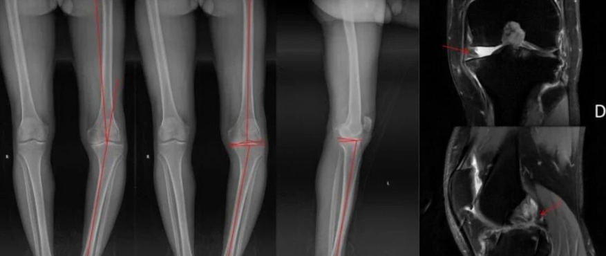 单间室膝关节置换术联合后交叉韧带重建