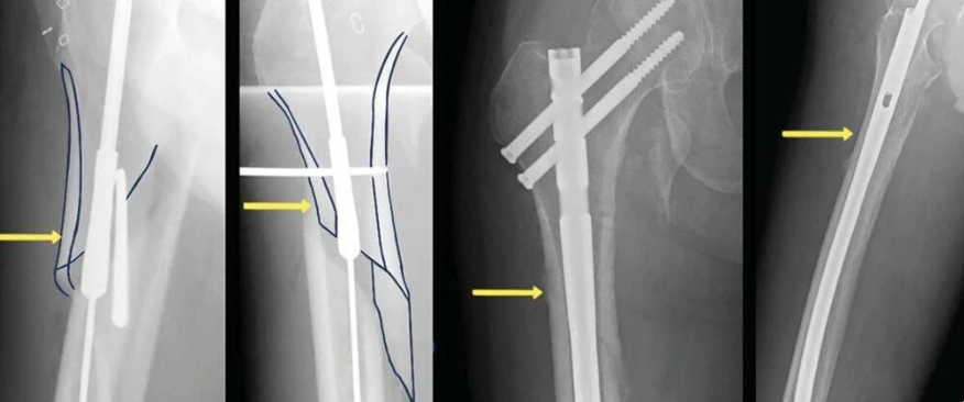 手术技巧 | 髓内钉治疗股骨转子下骨折完美复位技术
