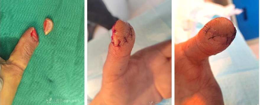 “精密对合，疏松缝合，” 原位缝合病例分享