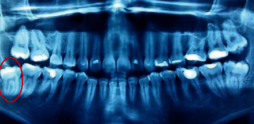 智齿拔除，术中意外发生下颌骨骨折