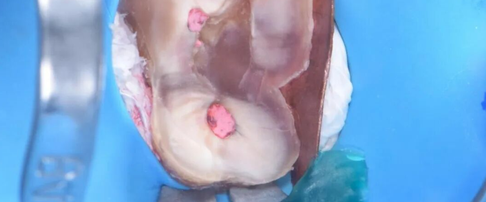 仿生牙科学中的生物基底层设计，这个案例讲明白了