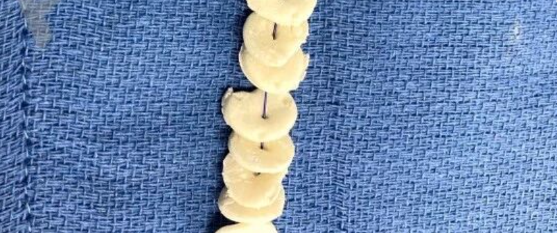 抗生素骨水泥链珠：一种最大化水泥珠表面积与体积比以提高抗生素洗脱率的技术技巧