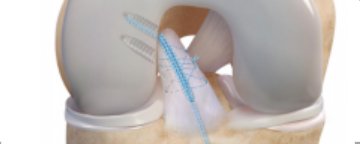 图文详解关节镜下如何实现对前交叉韧带近端撕裂的精准修复