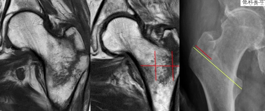 为什么需要警惕“孤立性股骨大转子骨折”？