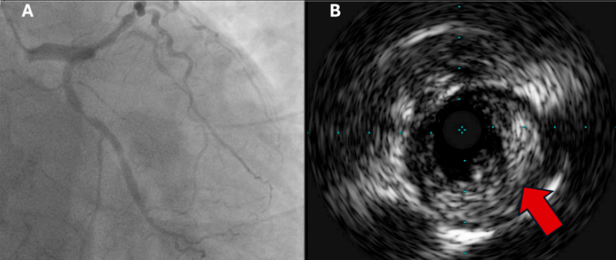 急性冠脉综合征：最新进展