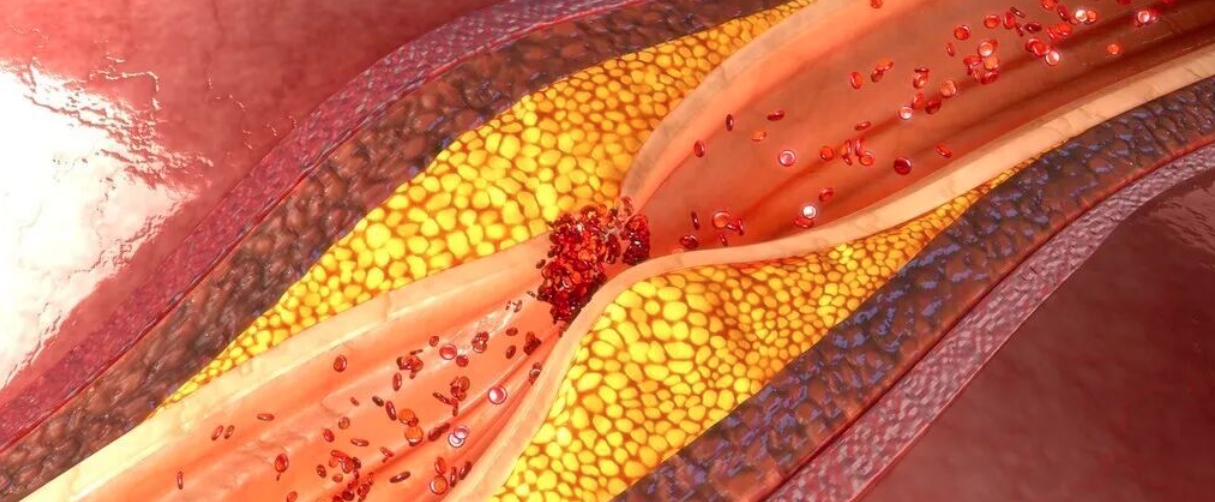 吃他汀类药物的时候，一定要搭配阿司匹林吗？注意不要过度治疗