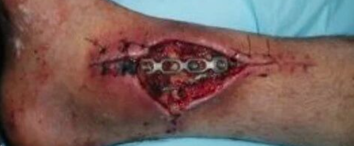 骨折相关感染生物标志物，哪些内植物可保留？