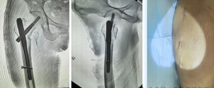 骨钩一钩定乾坤，85后高龄 ，速战速决，安全下台！