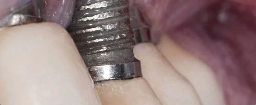 种植体周围炎的药物治疗管理