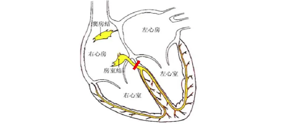 心律解码 | 常见室上速的药物及射频消融治疗精要