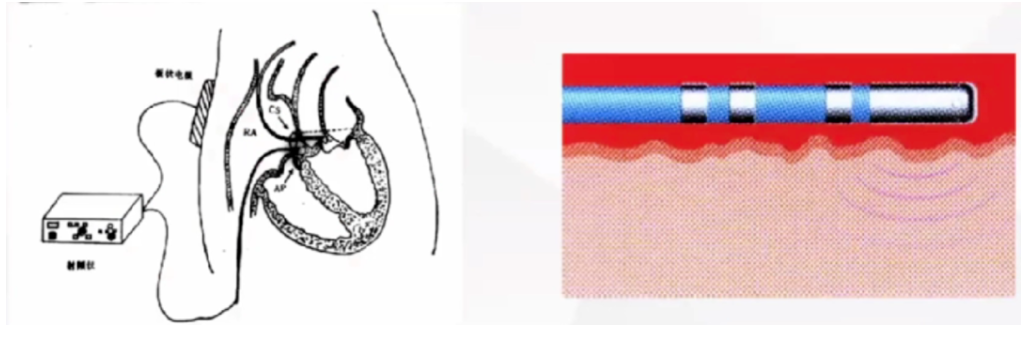 心律解码 | 谁还不会心律失常的处理？这份专家秘籍分享给你