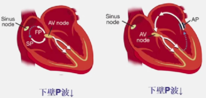 心律解码丨室上性心动过速诊断与治疗，一文详解！