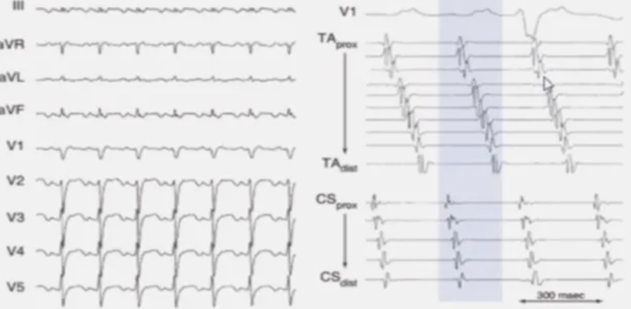 心律解码 丨 房性心动过速的心电图特点及治疗，心血管必备干货！