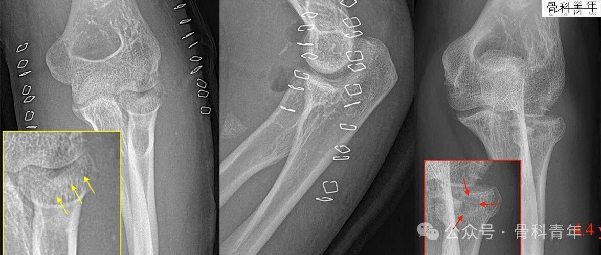 【手术技术】可吸收螺钉/克氏针内固定治疗桡骨头骨折