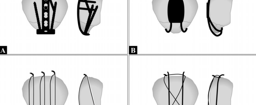 髌骨下极骨折的手术治疗技巧，你都掌握了吗？