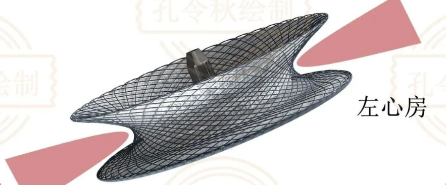 房间隔缺损大小，到底如何测量？