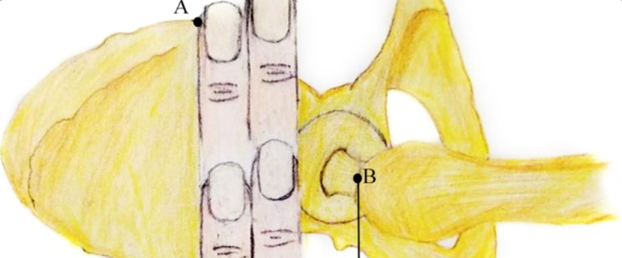  “三指法”辅助PFNA治疗股骨转子间骨折