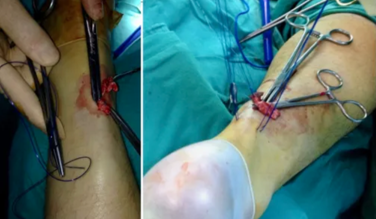 【手术技术】借助卵圆钳辅助修复急性跟腱断裂