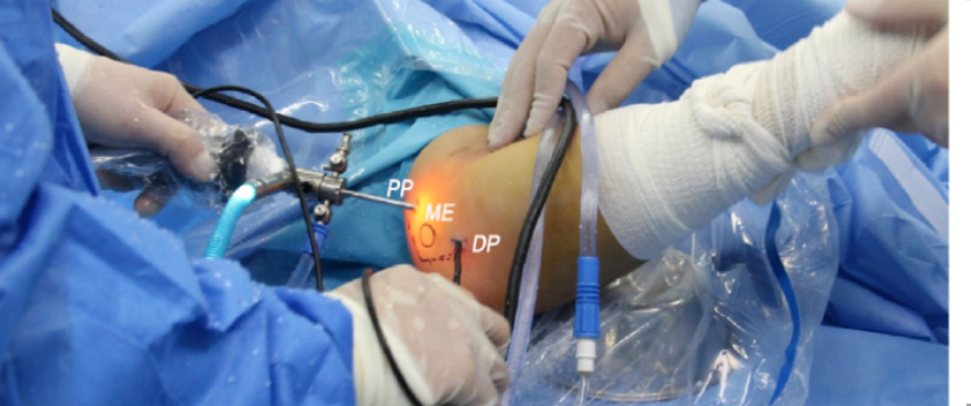 全关节镜下尺神经松解并皮下前置术