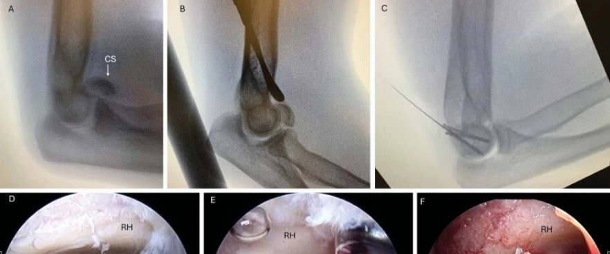 JAAOS：5种肘关节骨折内固定手术入路，100％干货！