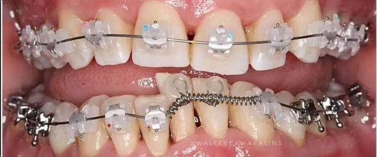 这样的正畸，该怎么收费