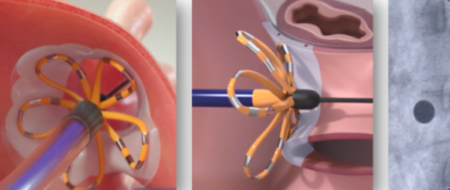 房颤脉冲消融围手术期管理：一例术后溶血病例的临床启示