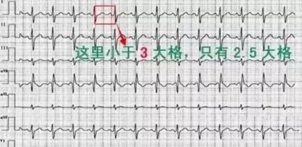 教你心电图，没有理由看不懂！