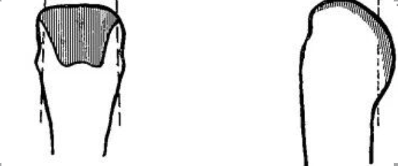 经关节截指——是否保留软骨？