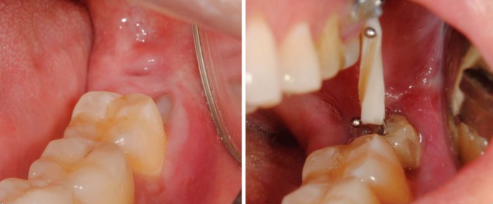 智齿已经压迫了神经，用这个方法拔，很安全