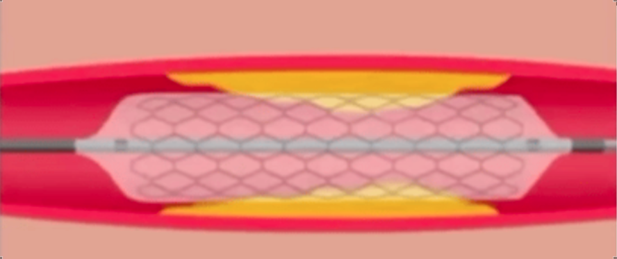 介入笔记 | 抽吸导管如何使用，这些技巧你需要知道！